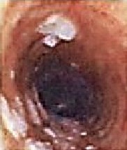 Hyperflexion-rollkur-the horse is more conflictive because faster airflow damages its throat. Another problem can be mucus. This image shows grade 4 tracheal mucus