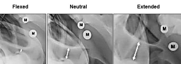 Hyperflexion-rollkur-the horse is more conflictive because its airflow is blocked. This image shows three views of trachea, flexed, normal and extended